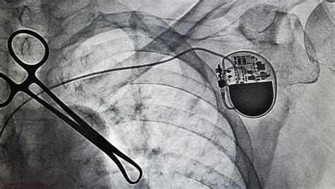 Practical Tips For Pacemaker MRI Safety Protocols - Radiology Vine