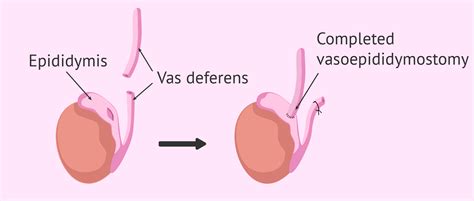 Procedure Of A Vasectomy