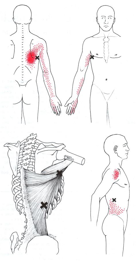 Latissimus Dorsi | The Trigger Point & Referred Pain Guide