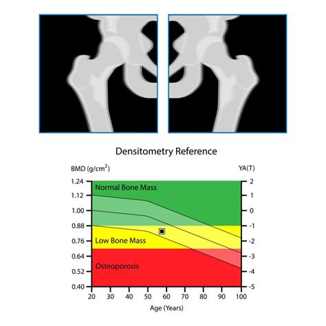 Osteoporosis Bone Density Scale