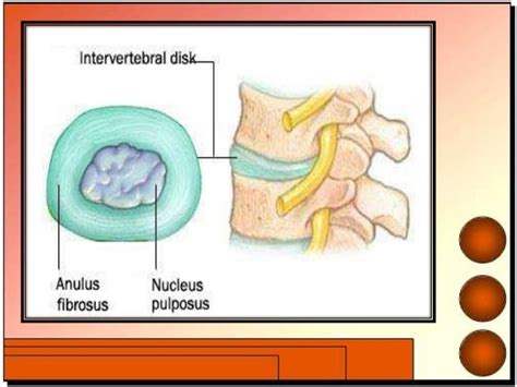 Herniated Nucleus Pulposus