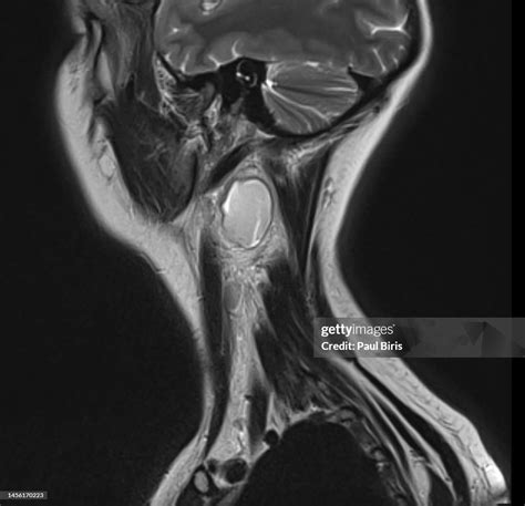 Mri Findings Of Branchial Cleft Cysts Sagittal T2 View High-Res Stock ...