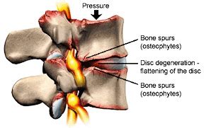 Cervical Degenerative Disc Disease & Mechanical Neck Pain