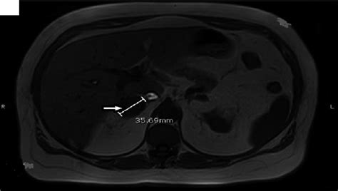 Magnetic resonance imaging (MRI) abdomen with and without contrast ...