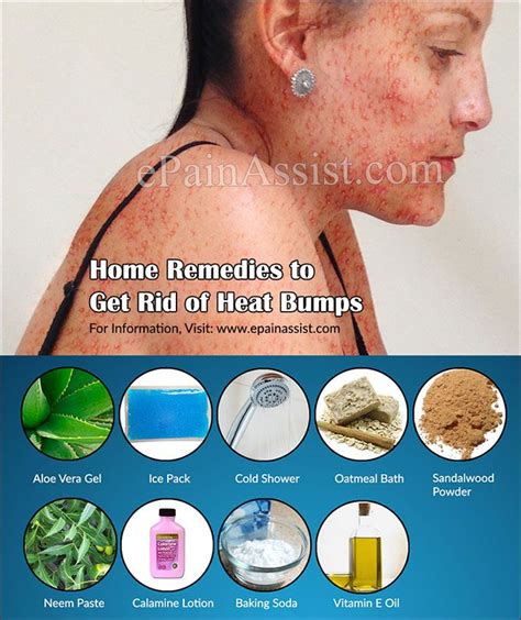 Causes Of Heat Bumps Amp Home Remedies To Get Rid Of It - Riset