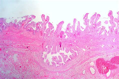 Gallbladder: Rokitansky-Aschoff Sinus | Ed Uthman | Flickr