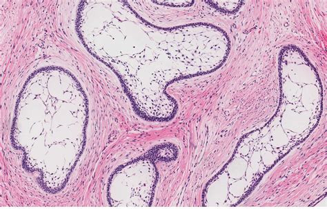 Unicystic Ameloblastoma Histology