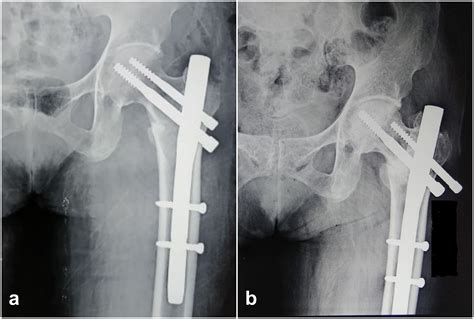 Cureus | Surgical Treatment of Type 31-A1 Two-part Intertrochanteric Femur Fractures: Is ...