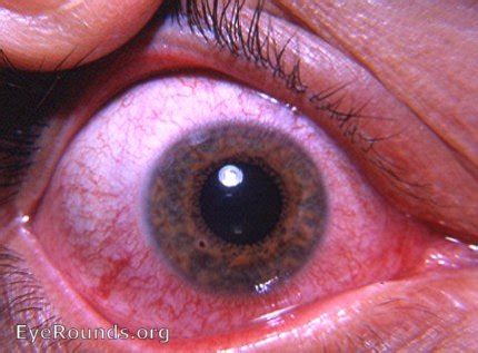 Rust foreign body in cornea. EyeRounds.org: Online Ophthalmic Atlas