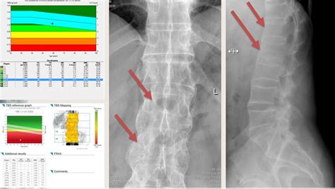 BMD—normal bone density. TBS—osteoporosis. X-ray—fractures in first and... | Download Scientific ...