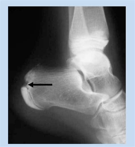 Lateral radiograph of the calcaneus demonstrates fragmentation and... | Download Scientific Diagram