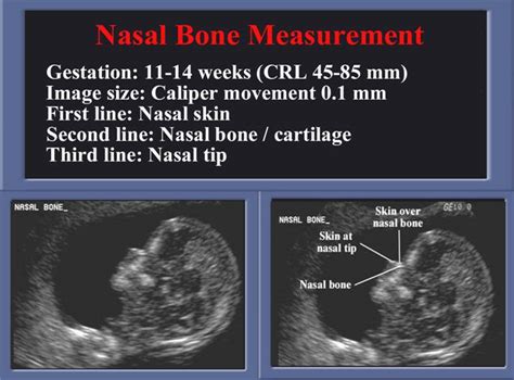 Normal Nasal Bone Ultrasound