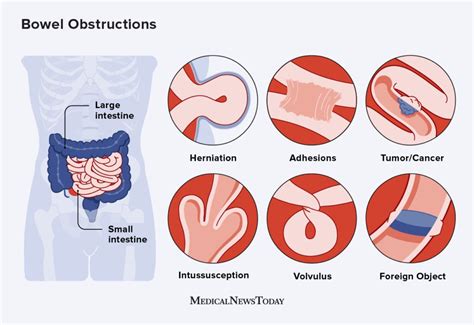 Bowel obstruction: Symptoms, causes, treatment, and diet