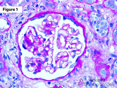 Kappa Light Chain Cast Nephropathy | Teaching Point | Arkana Labs