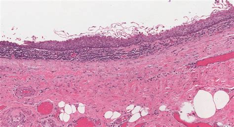 Branchial cleft cyst | Ottawa Atlas of Pathology