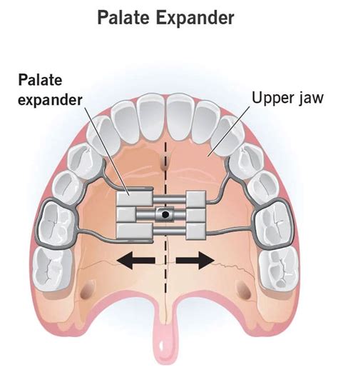 What is an Orthodontic Expander & When is it Necessary?