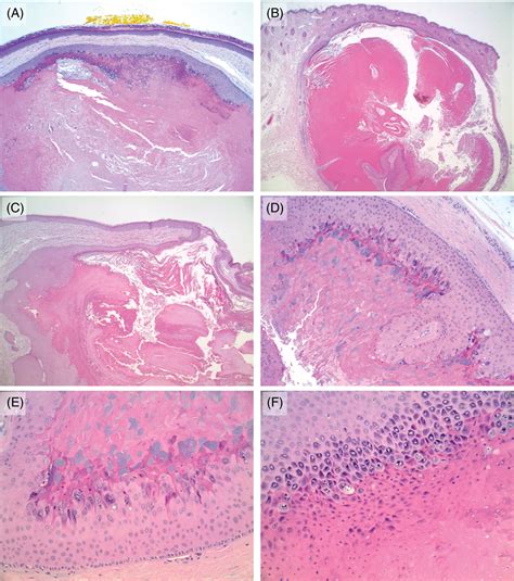 Pedicab Énfasis crisantemo pilar cyst histology índice novato Condición