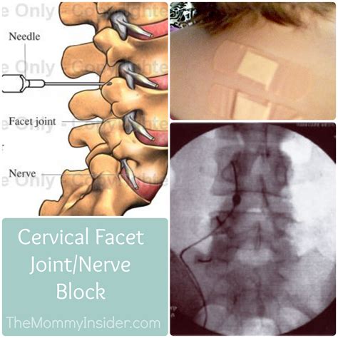 Personal: About My Cervical Facet Joint Block Procedure And The Day After | The Mommy Insider