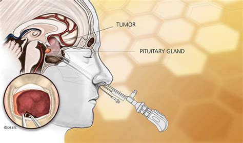 The resilient pituitary gland: What happens when the pituitary gland has to be cut during ...