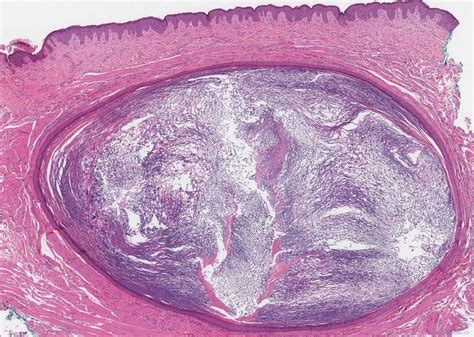 Epidermoid cyst | Atlas of Pathology