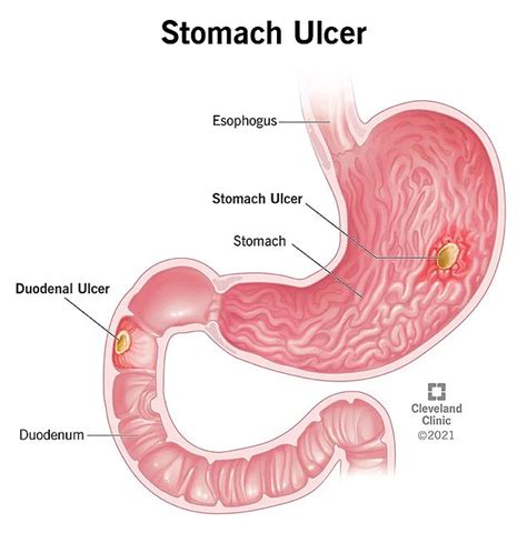 What is peptic ulcer disease? The condition forcing Bruce Springsteen to postpone his shows ...