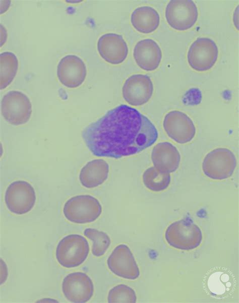 T-LGL leukemia - Peripheral smear - Figure 2