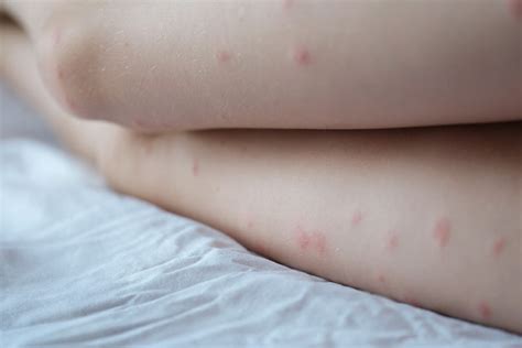 Blackheads On Legs: Causes, Prevention & Blackhead Removal Tips