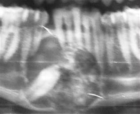 Case 17: Calcifying Odontogenic Cyst | Download Scientific Diagram