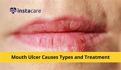 Mouth Ulcer Causes, Types and Treatment