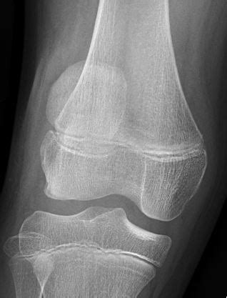 Knee Patellar Dislocation X Ray