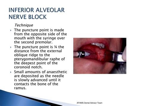 Inferior Alveolar Nerve Block PPT