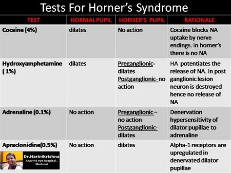 Test for Horner's Syndrome - EyeToday