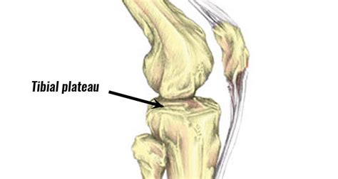 Medial Tibial Plateau Pain