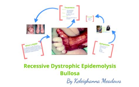 Recessive Dystrophic Epidermolysis Bullosa (RDEB) by Keleighanna Meadows on Prezi