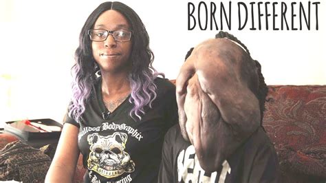 BOY BORN WITH FACE FULL OF TUMORS || REACTING TO BORN DIFFERENT #cancer #borndifferent - YouTube