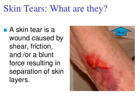 Skin Tear: una nuova frontiera da esplorare | Nurse Times