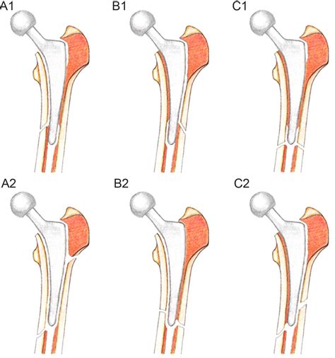 Fracture patterns according to the 3 radiographic zones (medial,... | Download Scientific Diagram