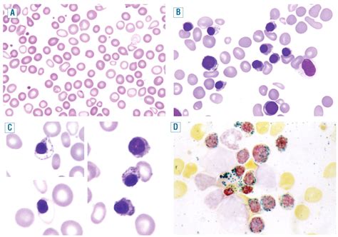 Ring sideroblasts and sideroblastic anemias | Haematologica