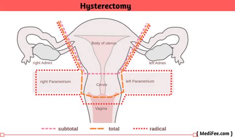 Uterus Removal Surgery - Hysterectomy Full Procedure, Risks and ...