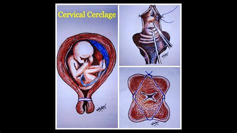 Cervical Cerclage : Mc'Donalds procedure by Dr.Avijit Basak - YouTube