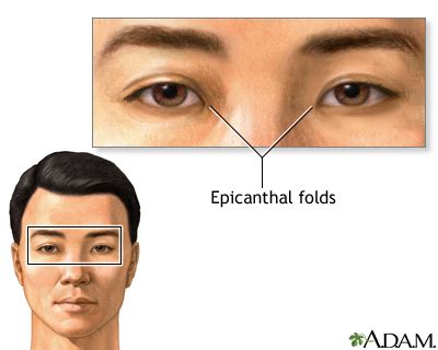 Epicanthal folds | UF Health, University of Florida Health