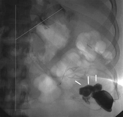 Complications Of Adjustable Gastric Banding, A Radiological, 55% OFF