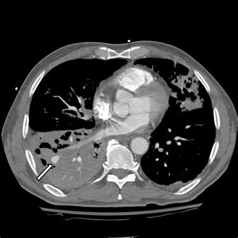 American Thoracic Society - A 67-Year-Old Man with Massive Hemoptysis