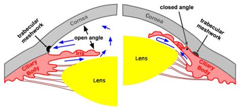 Acute angle closure glaucoma — Medlibes: Online Medical Library