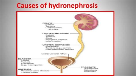 Hydronephrosis