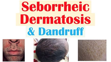 Seborrheic Dermatitis (Dandruff and Cradle Cap) Causes, Risk Factors ...