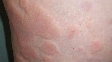 What Is Chronic Idiopathic Urticaria and How Is It Treated?