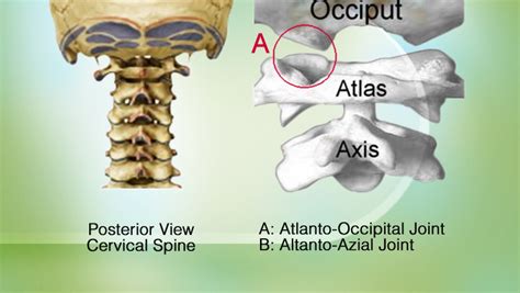 Atlanto-Occipital Joint; Atloido-Occipital Joint