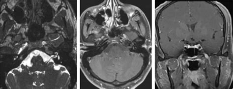 Figure 1 from Cranial mononeuritis multiplex as the initial manifestation of systemic lupus ...