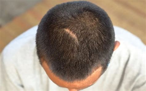 Hair transplant: covering and leaving scar tissue - Cosmedica